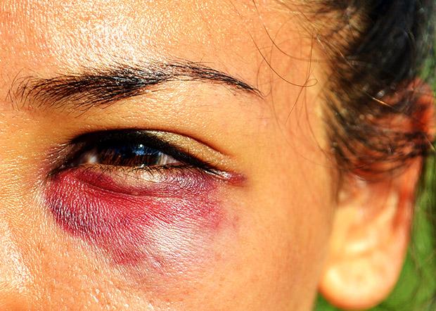 Claudia Rocha, a junior kinesiology major and women's rugby rookie, received a black eye while playing in a torunament during preseason. Photo credit: Laura pierson / Contributor